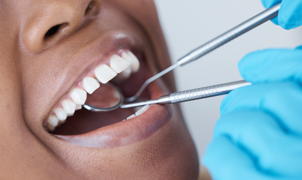 Etobicoke dentist offers veneers